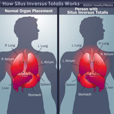image of normal organ placement versus person with situs inversus totalis