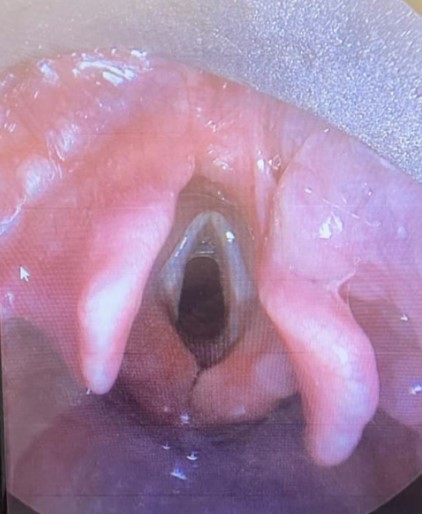 Image of bifid epiglottis