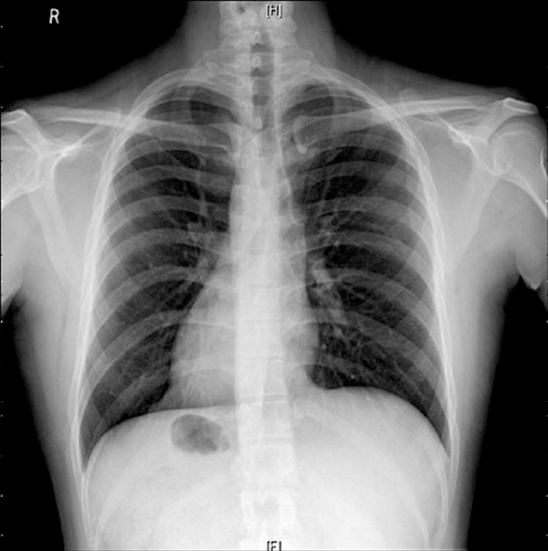 x ray of person with heart pointing to the right and stomach located on the right side of the body